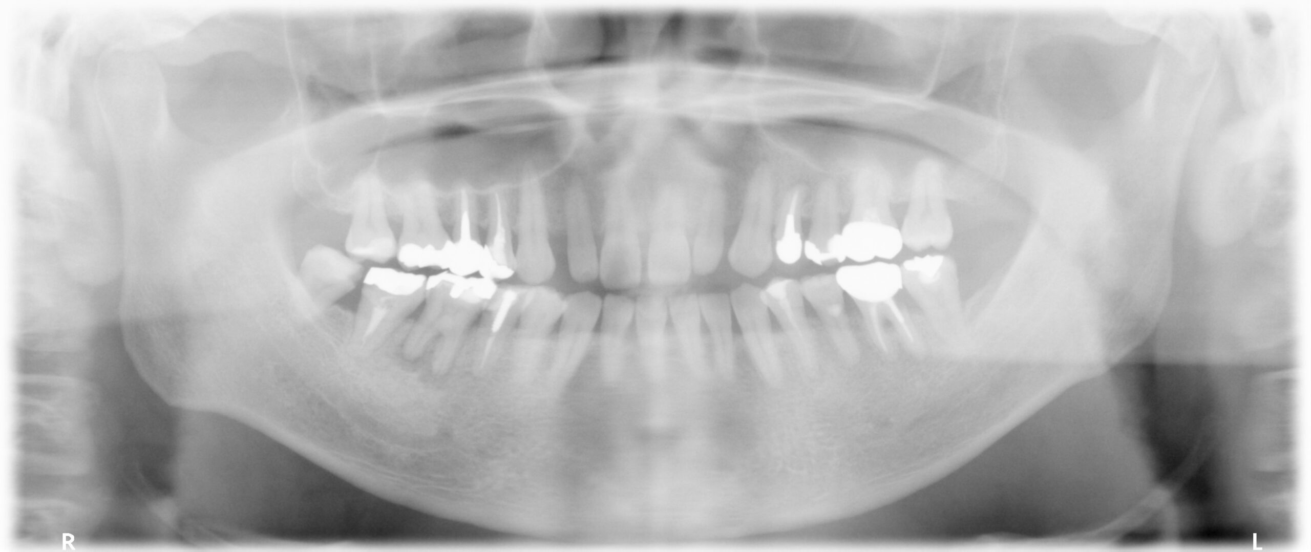 症例写真 レントゲン
